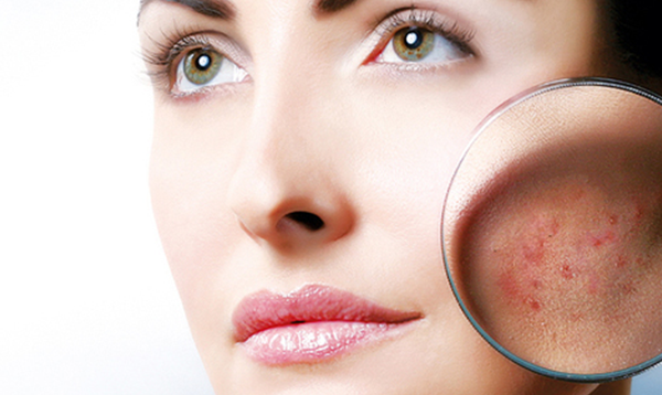 Лечение постакне